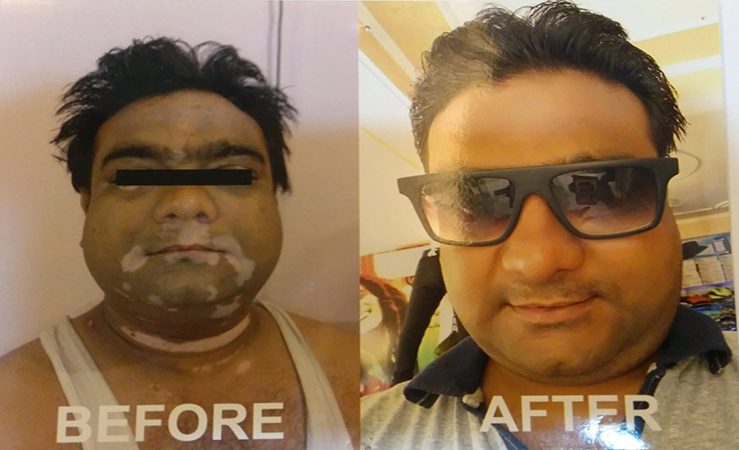 Vitiligo treatment in Faridabad